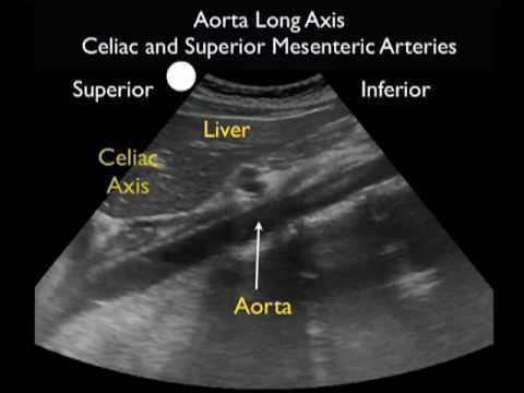 Abdominal Aortic Ultrasound