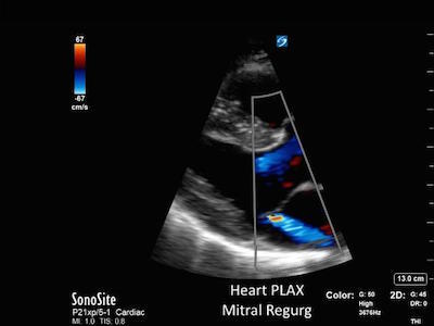 Sonosite ultrasound for cardiology