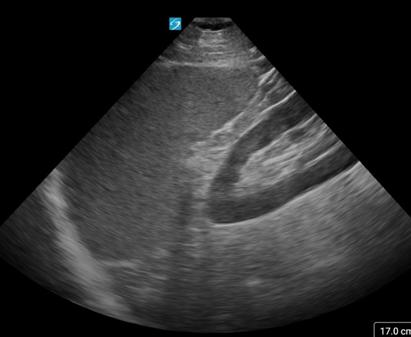 LUQ (Left Upper Quadrant)