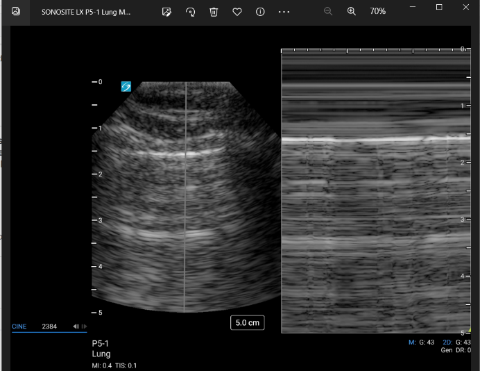 Lung View