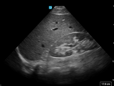 RUQ (Right Upper Quadrant)