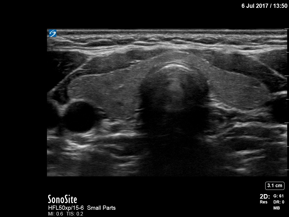 XP HFL50 - 甲状腺 | FUJIFILM Sonosite