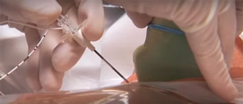 Ultraschall in der Anästhesie