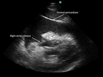 SonSite ultrasound for cardiology