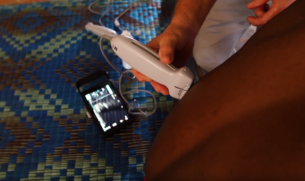 Sonosite handheld ultrasound for global health missions