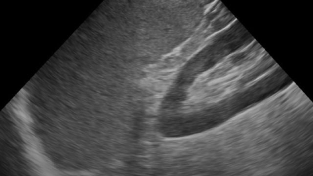 Left Upper Quadrant (LUQ) – eFAST