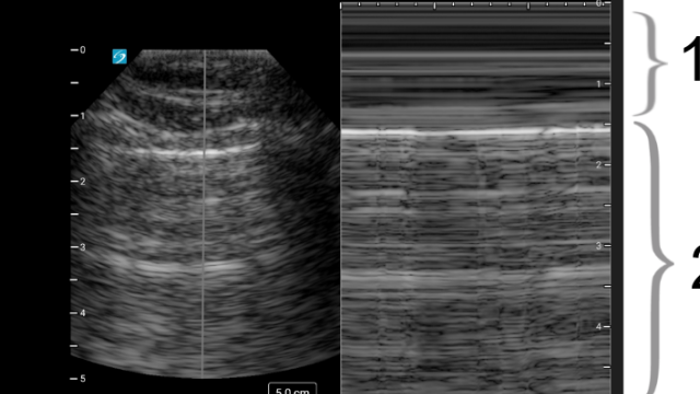 Lung view – eFAST