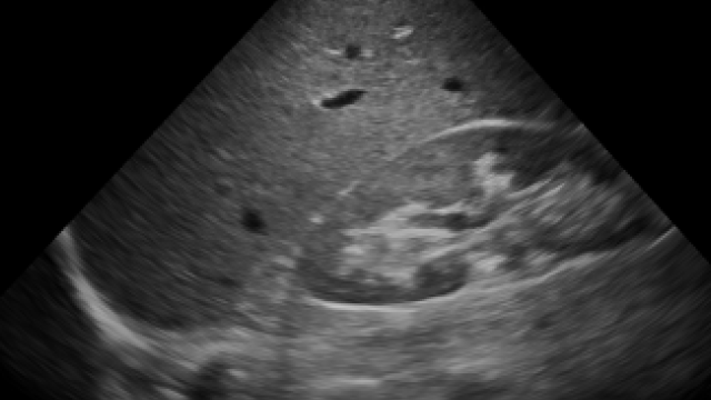 RUQ (Right Upper Quadrant) – eFAST