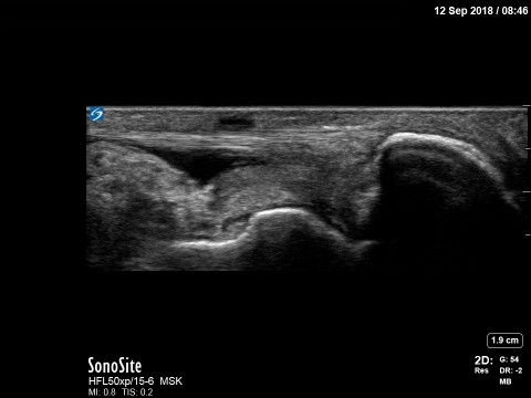 Sonosite X-Porte Ankle Fluid