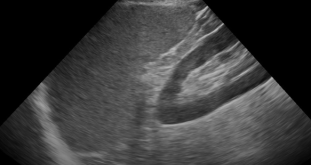 Left Upper Quadrant (LUQ) – eFAST