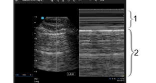 Lung view – eFAST