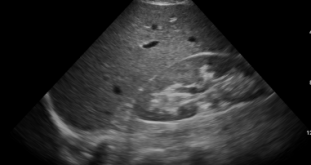 RUQ (Right Upper Quadrant) – eFAST