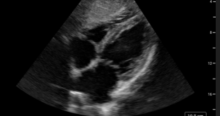 Understanding eFAST Ultrasound | FUJIFILM Sonosite