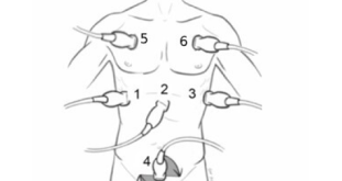 eFAST Lung